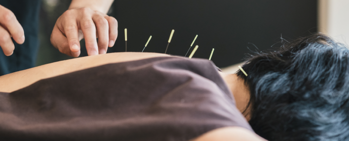 Acupuncture